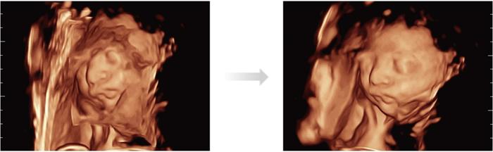 Care este diferenta dintre ecografia 2D, 3D si 4D? 679211