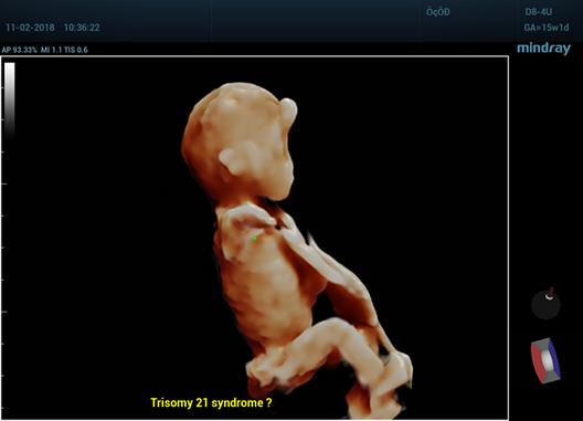 Care este diferenta dintre ecografia 2D, 3D si 4D? 679215