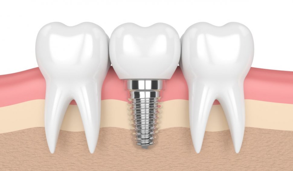 Implantul dentar – indicații pre și postoperatorii