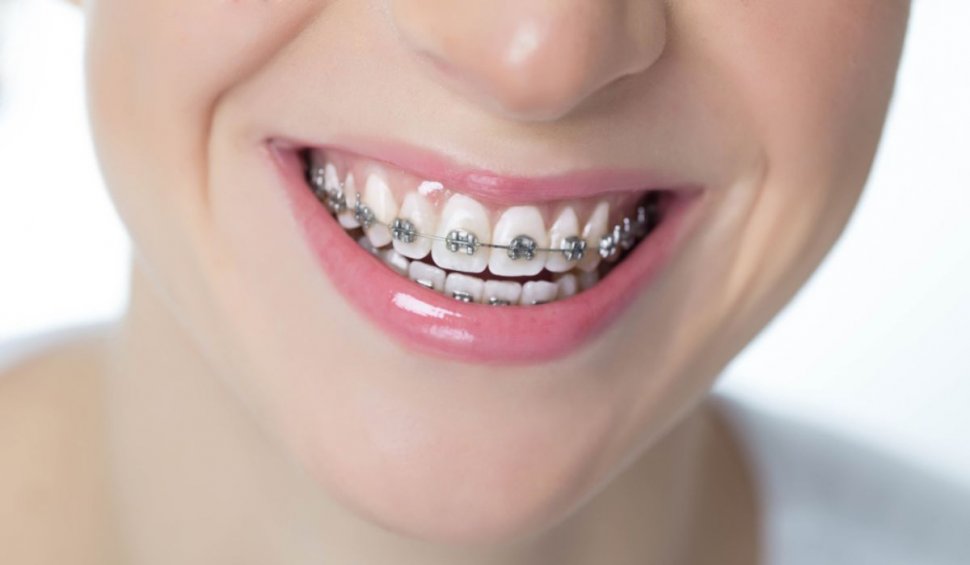 Periajul și îngrijirea dinților atunci când porți aparat dentar