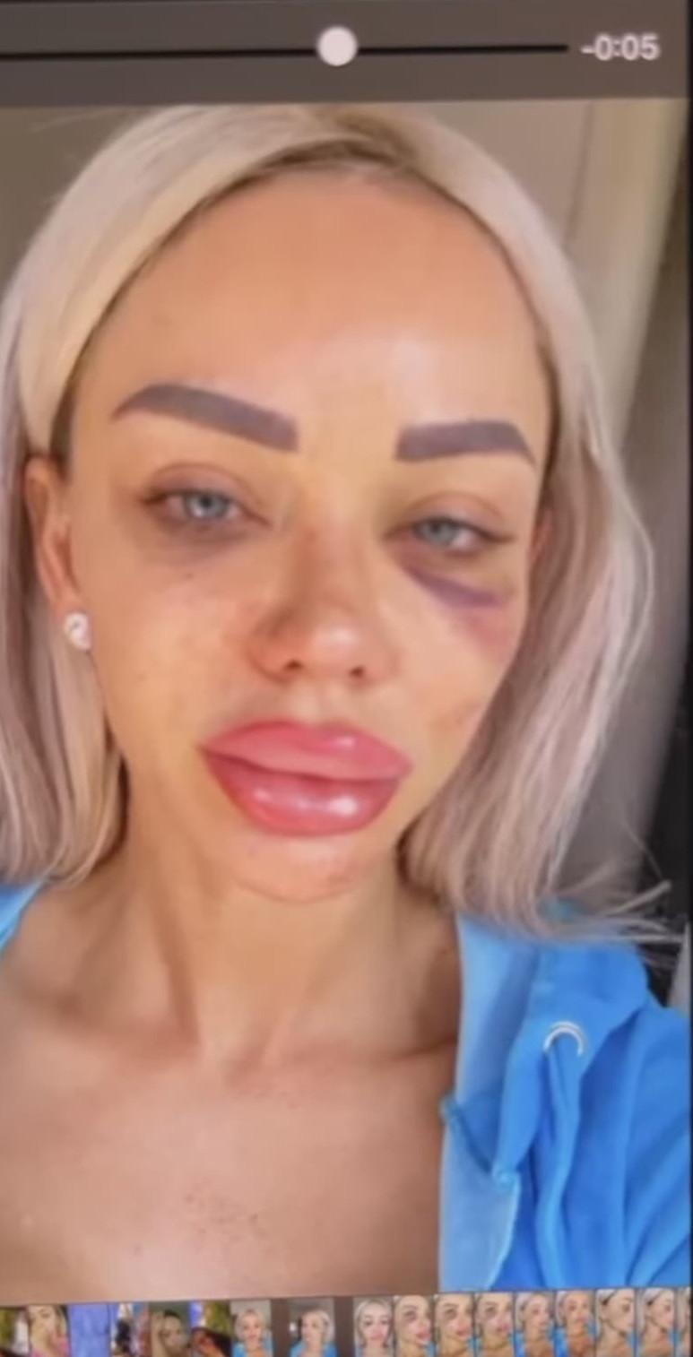 Bianca Drăgușanu a publicat pozele după bătaia primită de la Alex Bodi: ”Am un sfat: nu treceți cu vederea agresivitatea!” 694422