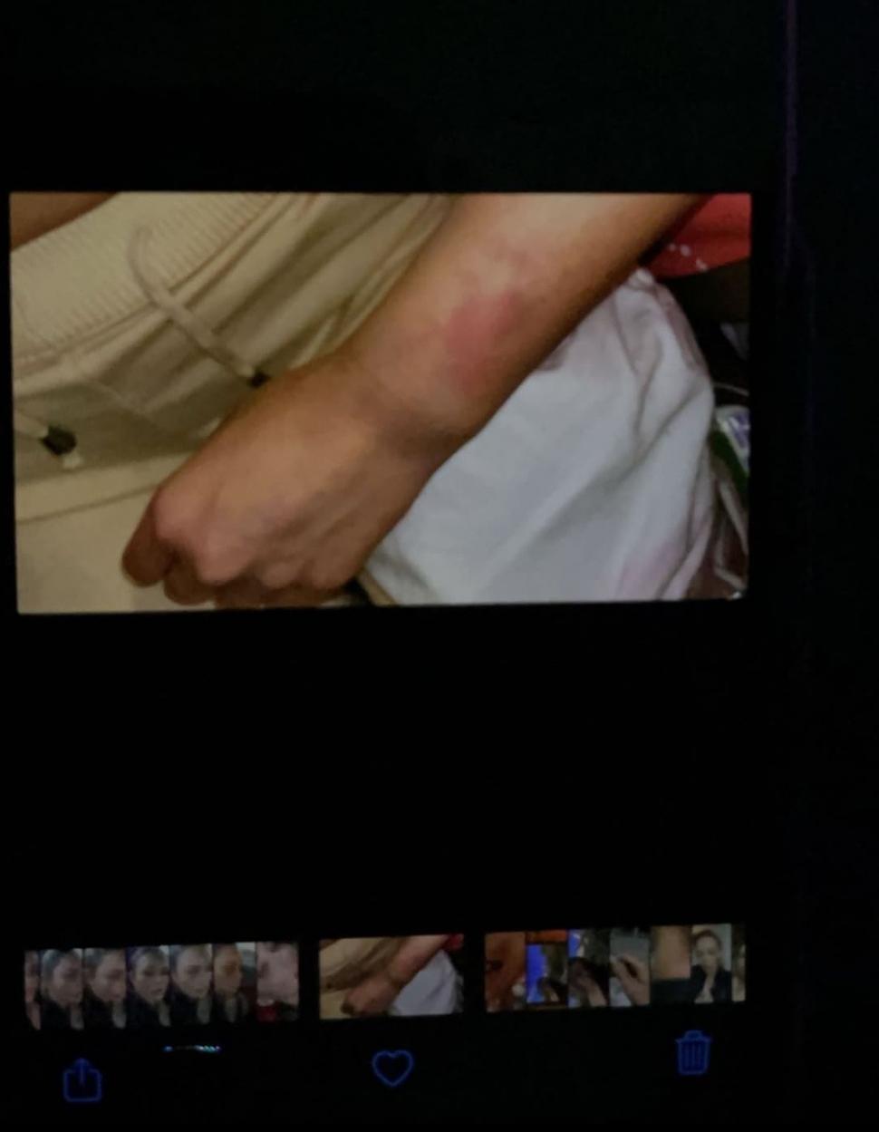 Bianca Drăgușanu a publicat pozele după bătaia primită de la Alex Bodi: ”Am un sfat: nu treceți cu vederea agresivitatea!” 694424