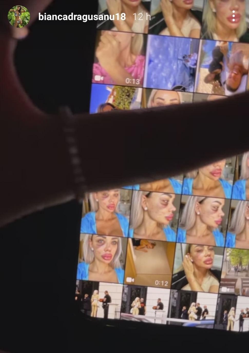 Bianca Drăgușanu a publicat pozele după bătaia primită de la Alex Bodi: ”Am un sfat: nu treceți cu vederea agresivitatea!” 694425