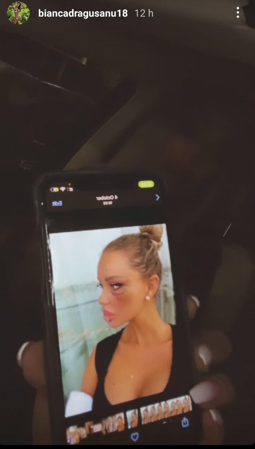 Bianca Drăgușanu a publicat pozele după bătaia primită de la Alex Bodi: ”Am un sfat: nu treceți cu vederea agresivitatea!” 694426