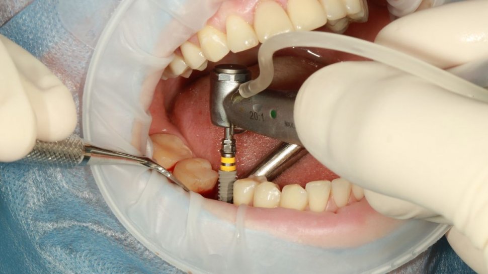 Soluția salvatoare pentru pierderea dinților! Beneficiile și riscurile unui implant dentar