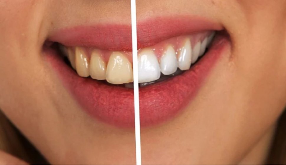 Albirea profesională nu strică dinţii. Dr. Epistatu ne spune cele cinci cauze care ne îngălbenesc dantura