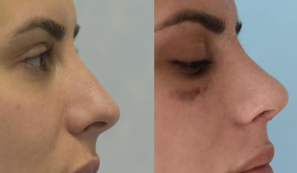 Ce trebuie să știi despre rinoplastie 708991
