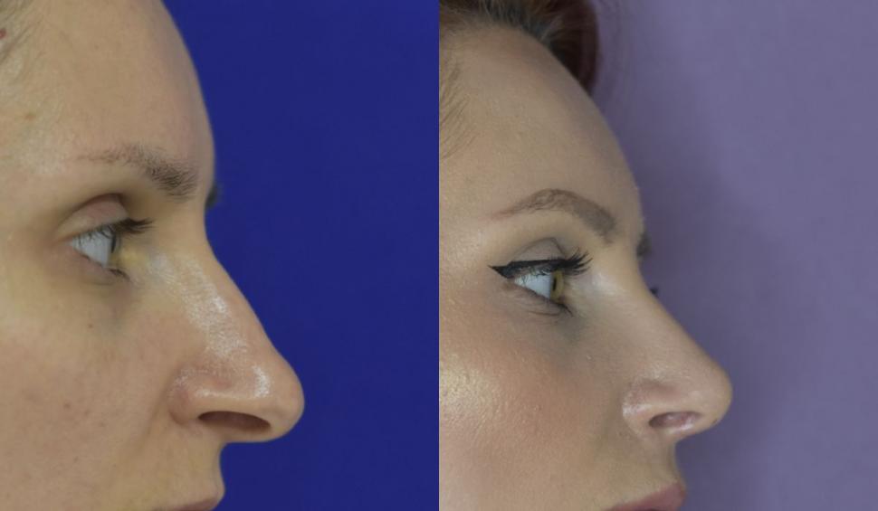 Ce trebuie să știi despre rinoplastie 708993