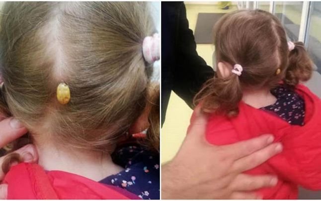 O fetiţă a ajuns la spital cu o căpuşă uriaşă pe cap, după ce s-a jucat într-un parc din Suceava