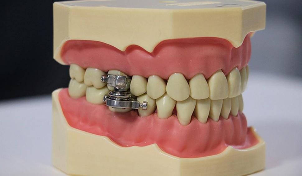 Revoluție în lupta contra obezității. A apărut dispozitivul cu magneți care te împiedică să deschizi gura ca să mănânci 713796