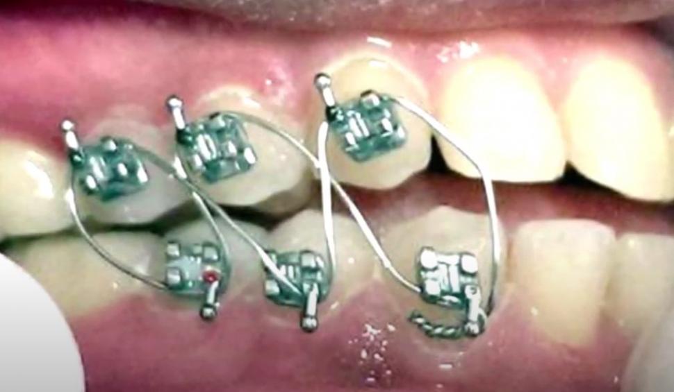 Revoluție în lupta contra obezității. A apărut dispozitivul cu magneți care te împiedică să deschizi gura ca să mănânci 713798