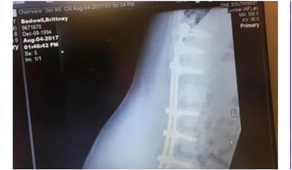 O viitoare mămică paralizată a realizat imposibilul și a mers în ziua nunții ei: ”Miracolele există!” 718353