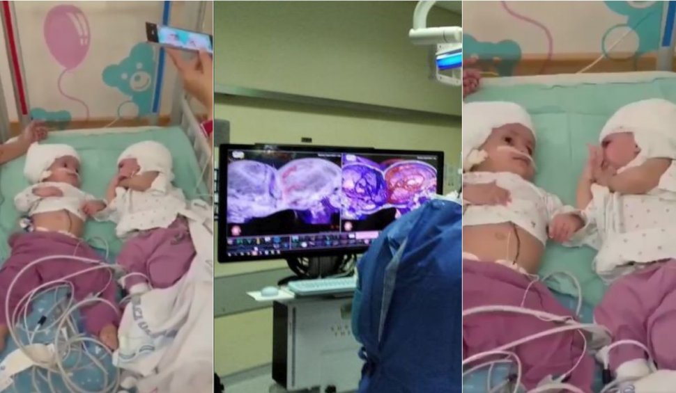 Două gemene unite la ceafă au fost separate chirurgical printr-o operație extrem de rară, în Israel