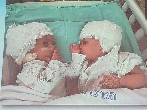 Două gemene unite la ceafă au fost separate chirurgical printr-o operație extrem de rară, în Israel 725551
