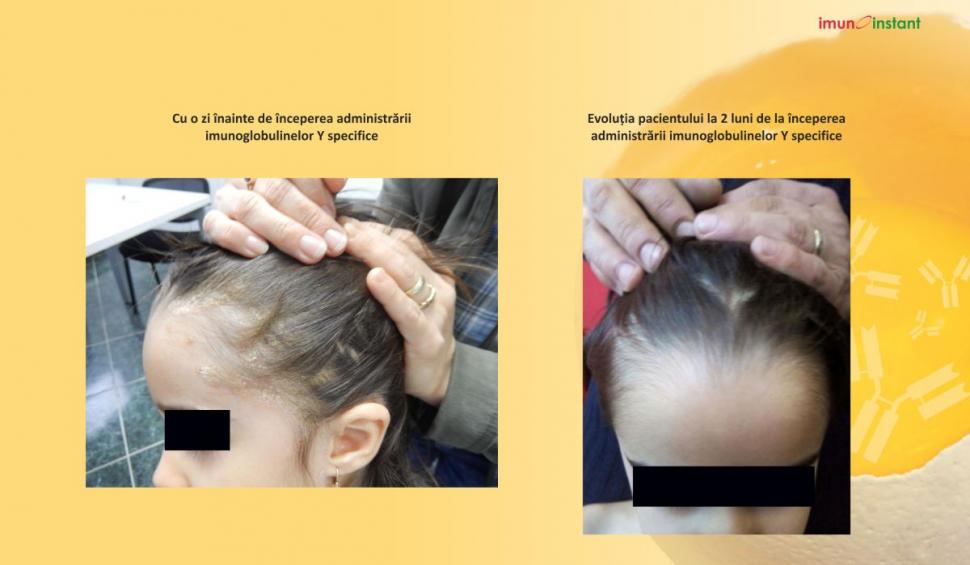 Psoriazisul vindecat clinic cu imunoglobuline Y Imunoinstant 739221