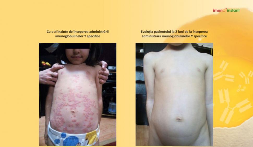 Psoriazisul vindecat clinic cu imunoglobuline Y Imunoinstant 739222