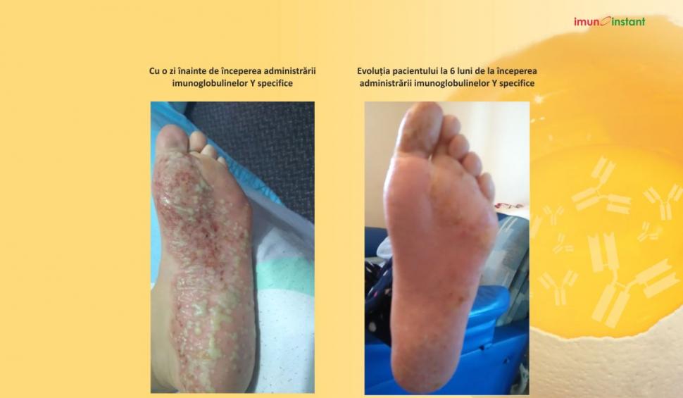 Psoriazisul vindecat clinic cu imunoglobuline Y Imunoinstant 739223