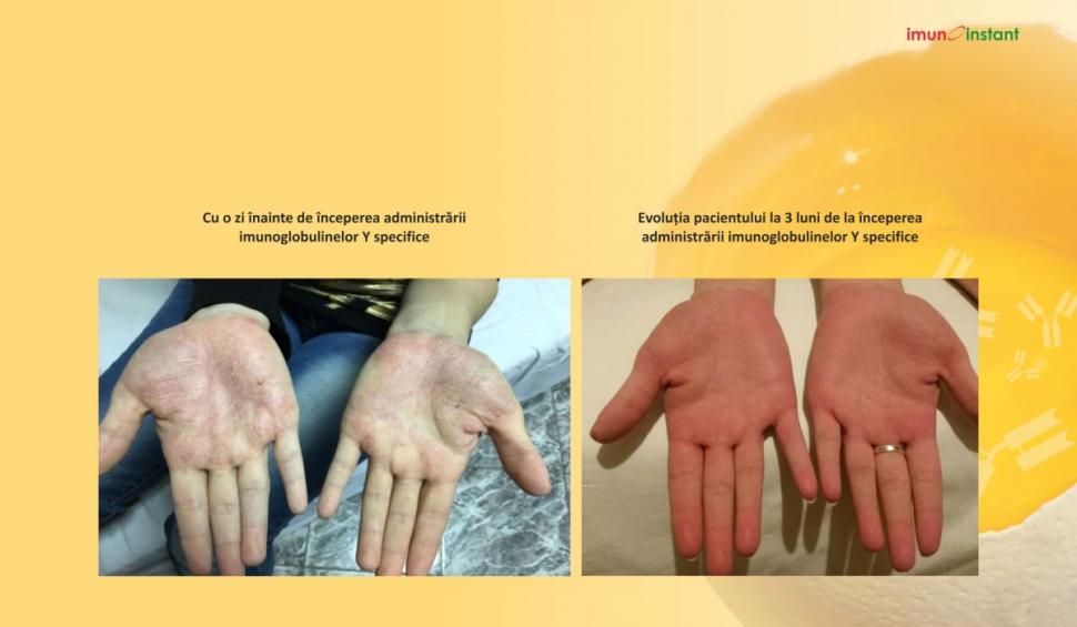 Psoriazisul vindecat clinic cu imunoglobuline Y Imunoinstant 739224