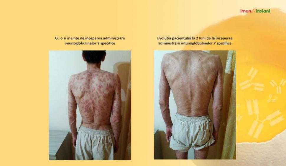 Psoriazisul vindecat clinic cu imunoglobuline Y Imunoinstant 739225