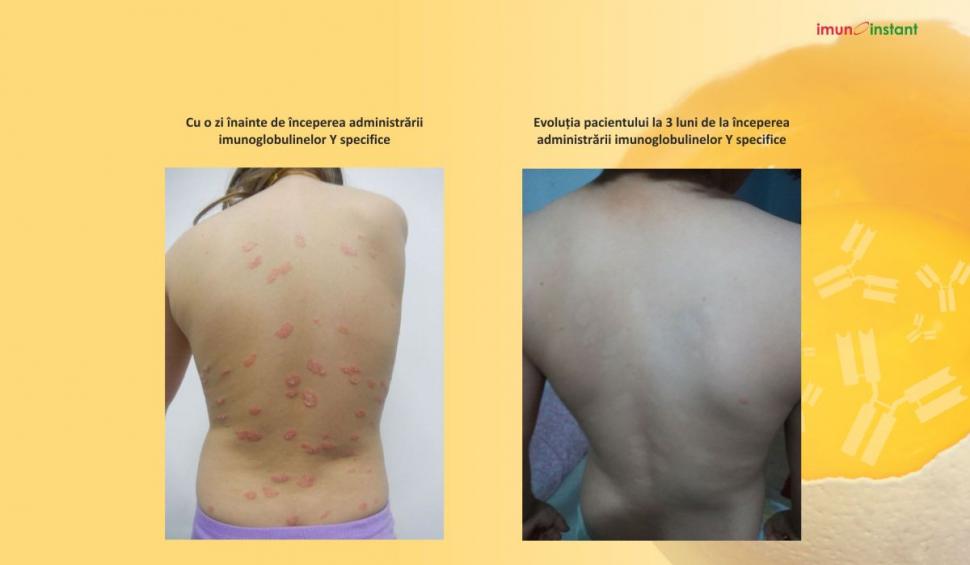 Psoriazisul vindecat clinic cu imunoglobuline Y Imunoinstant 739227