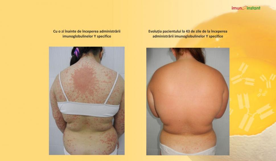 Psoriazisul vindecat clinic cu imunoglobuline Y Imunoinstant 739228