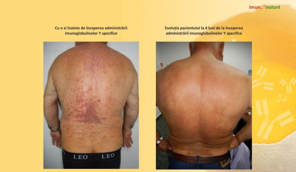 Psoriazisul vindecat clinic cu imunoglobuline Y Imunoinstant 739229