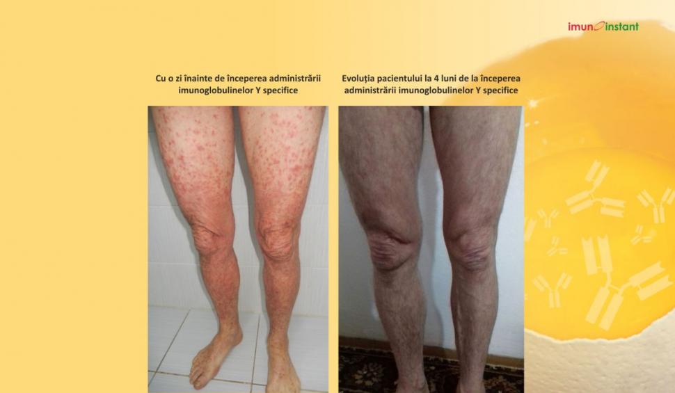 Psoriazisul vindecat clinic cu imunoglobuline Y Imunoinstant 739230