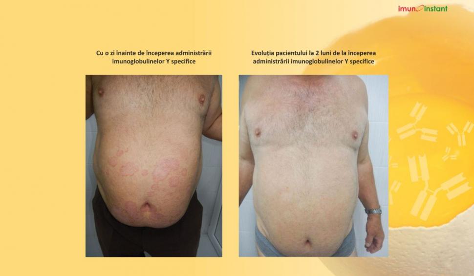 Psoriazisul vindecat clinic cu imunoglobuline Y Imunoinstant 739231