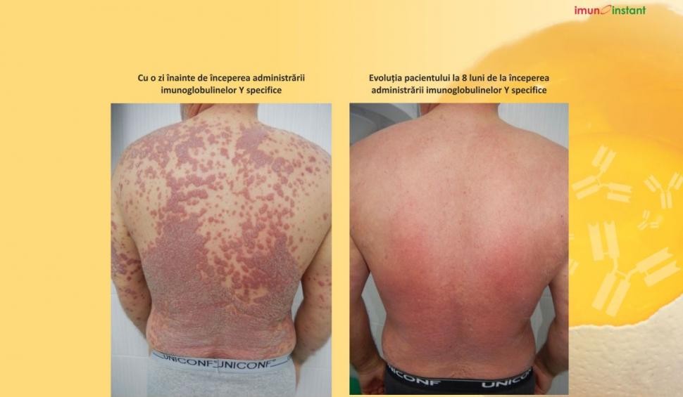 Psoriazisul vindecat clinic cu imunoglobuline Y Imunoinstant 739232