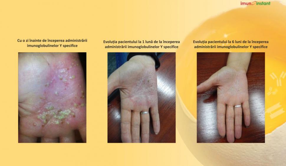 Psoriazisul vindecat clinic cu imunoglobuline Y Imunoinstant 739233