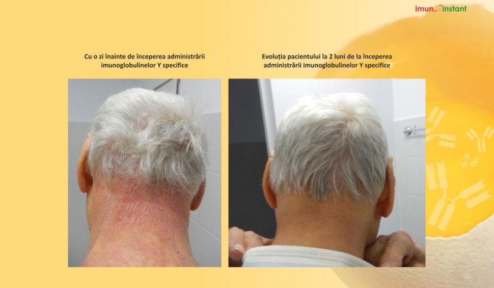 Psoriazisul vindecat clinic cu imunoglobuline Y Imunoinstant 739234