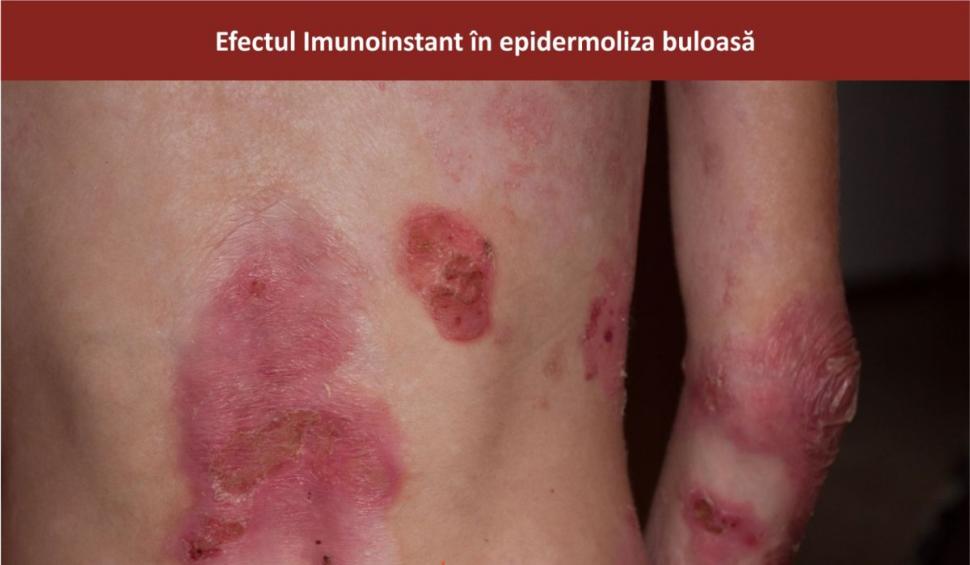 Afecțiunile dermatologice la copii și terapia adjuvantă cu imunoglobuline Y Imunoinstant  748942