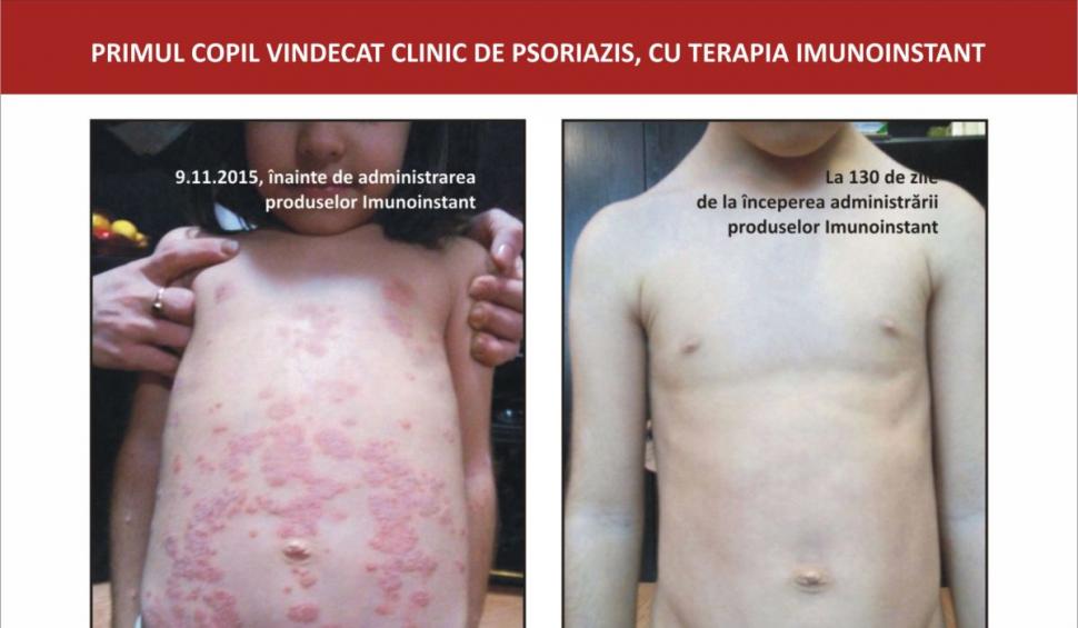 Afecțiunile dermatologice la copii și terapia adjuvantă cu imunoglobuline Y Imunoinstant  748944