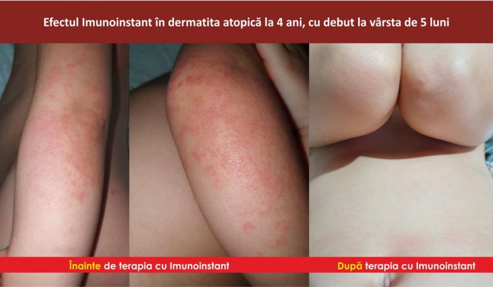 Afecțiunile dermatologice la copii și terapia adjuvantă cu imunoglobuline Y Imunoinstant  748946