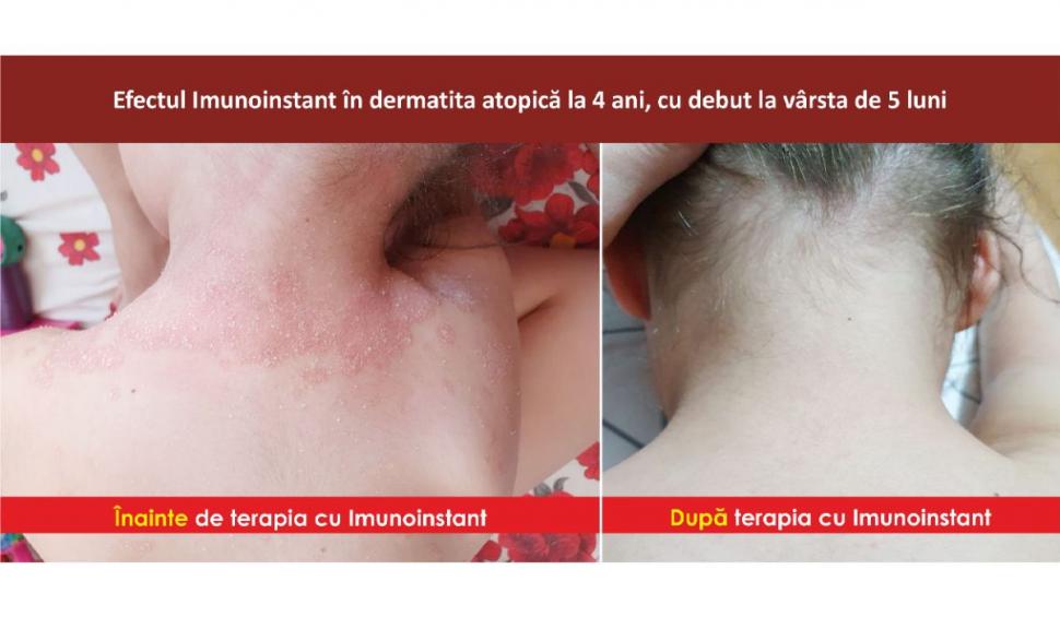 Afecțiunile dermatologice la copii și terapia adjuvantă cu imunoglobuline Y Imunoinstant  748947