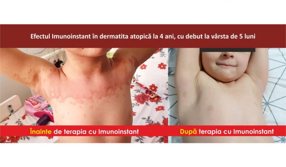 Afecțiunile dermatologice la copii și terapia adjuvantă cu imunoglobuline Y Imunoinstant  748948