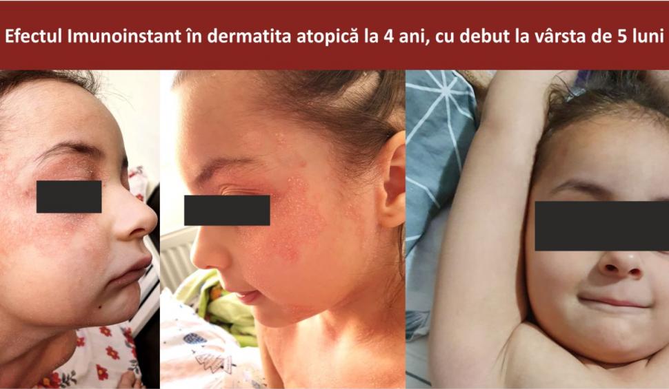 Afecțiunile dermatologice la copii și terapia adjuvantă cu imunoglobuline Y Imunoinstant  748949