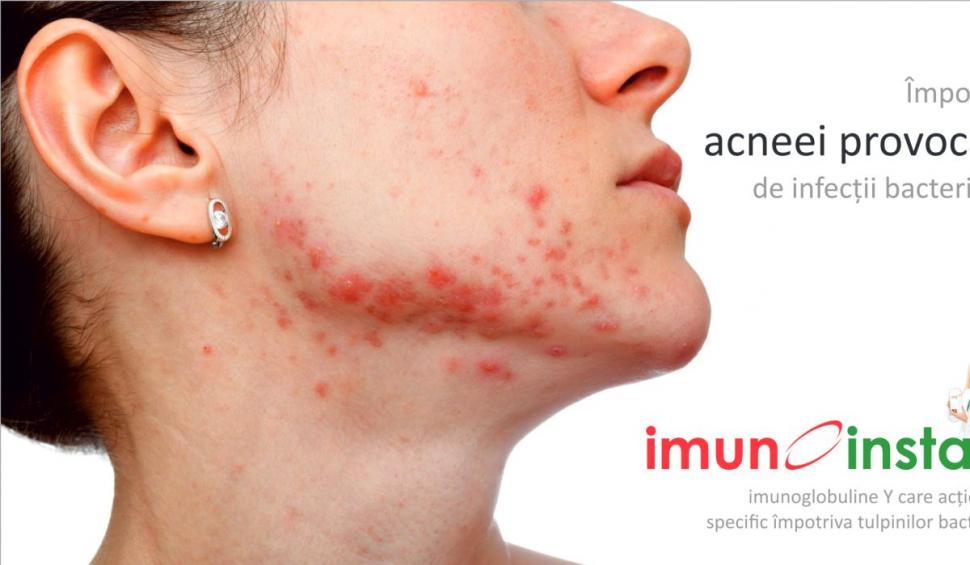 Imunoinstant, terapia complexă cu imunoglobuline Y specifice  împotriva acneei 753377