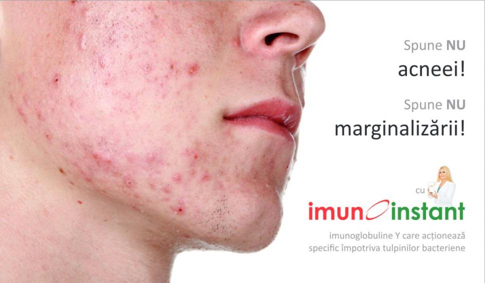 Imunoinstant, terapia complexă cu imunoglobuline Y specifice  împotriva acneei 753382