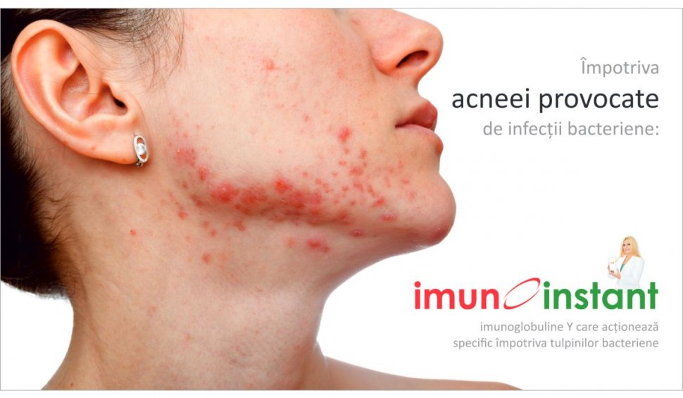 Imunoinstant, terapia complexă cu imunoglobuline Y specifice  împotriva acneei