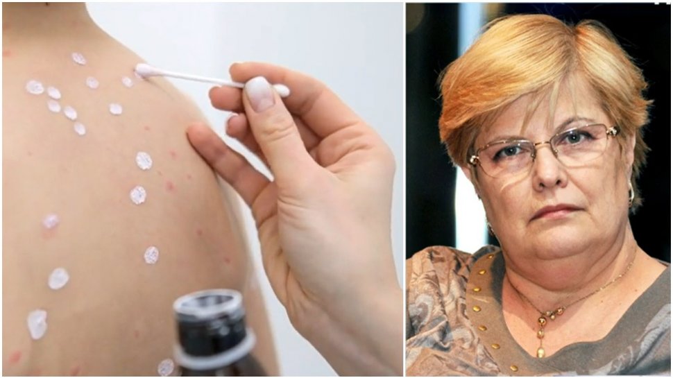 Se înmulţesc cazurile de varicelă la copii. Ce medicament e interzis să administraţi