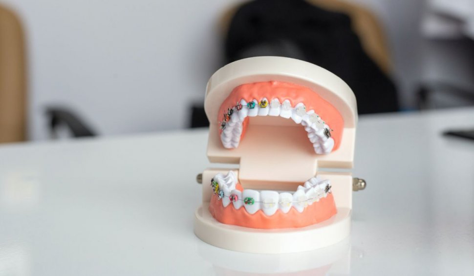Mituri despre aparatul dentar pe care nu trebuie sa le mai crezi