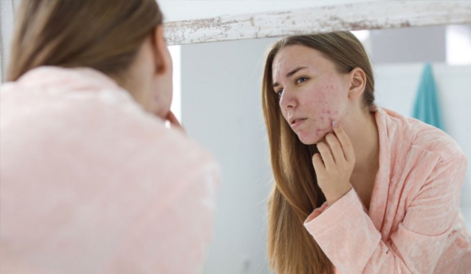 Ce poți face pentru a ameliora simptomele acneei