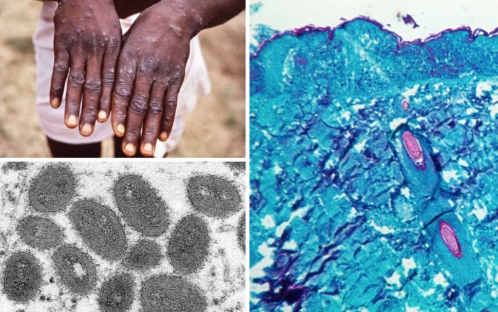 Ce este ”variola maimuței”, boala care a speriat epidemiologii din întreaga lume