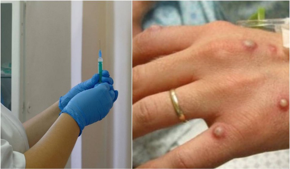 Vaccinul pentru combaterea variolei maimuței ajunge și în România. Ministerul Sănătății va cumpăra câteva sute de doze