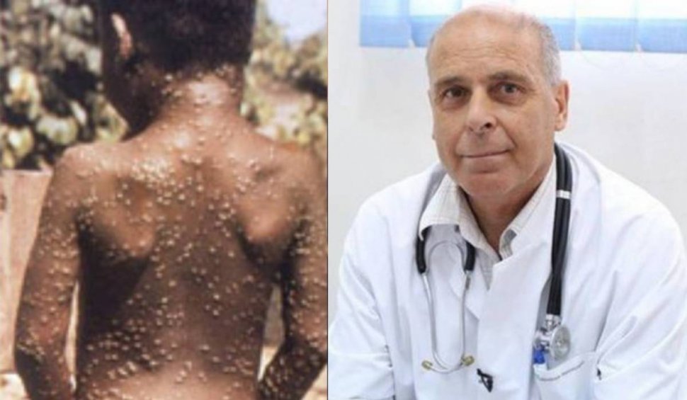 Virgil Musta, despre variola maimuței: ”Nu trebuie să ne temem de această boală”