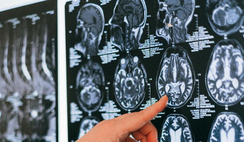 Face ravagii în creier, chiar și după vindecare. Prof. dr. Vlad Ciurea: ”Nu vreau să sperii pe nimeni, dar e real” 779831