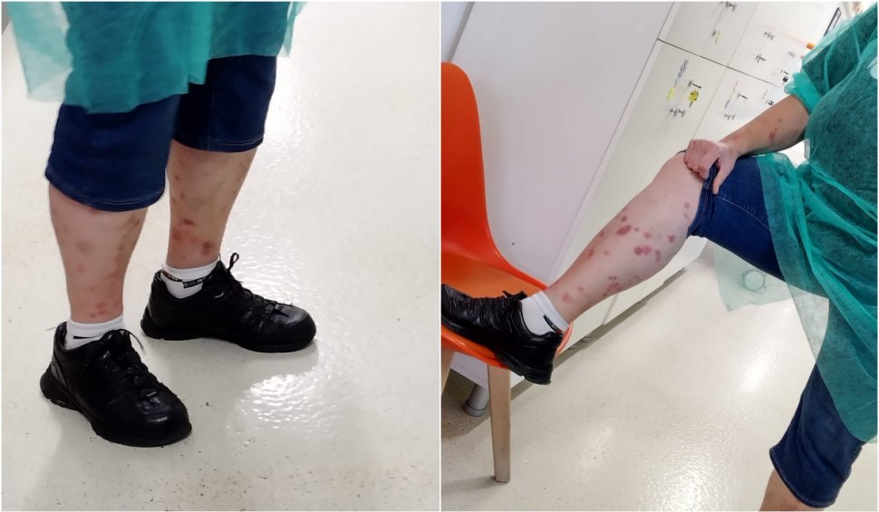 Ciupită de ploșnițe într-un hotel din România | O turistă a ajuns la spital după ce a fost într-o staţiune balneară