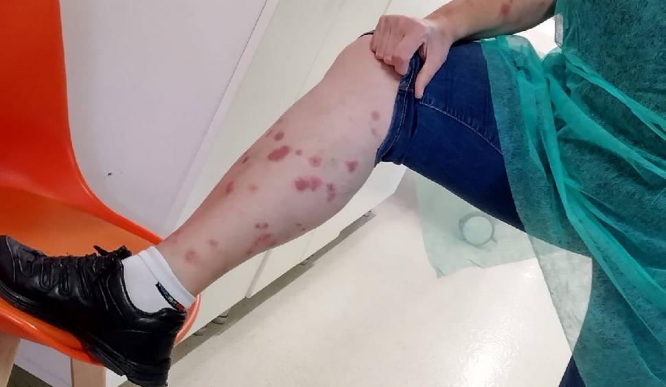 Ciupită de ploșnițe într-un hotel din România | O turistă a ajuns la spital după ce a fost într-o staţiune balneară 790383