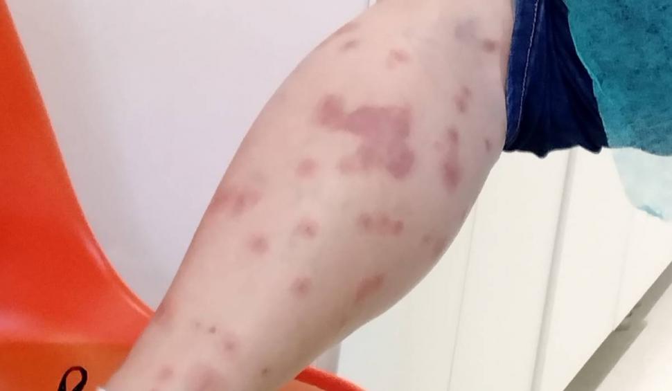 Ciupită de ploșnițe într-un hotel din România | O turistă a ajuns la spital după ce a fost într-o staţiune balneară 790384